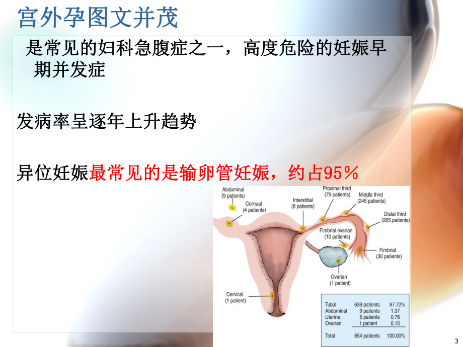 宫外孕并茂-课件.ppt_第3页