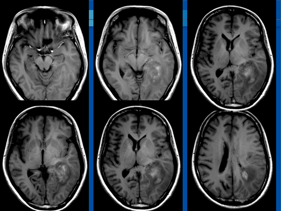 医学影像横纹肌样脑膜瘤读片课件.ppt_第3页