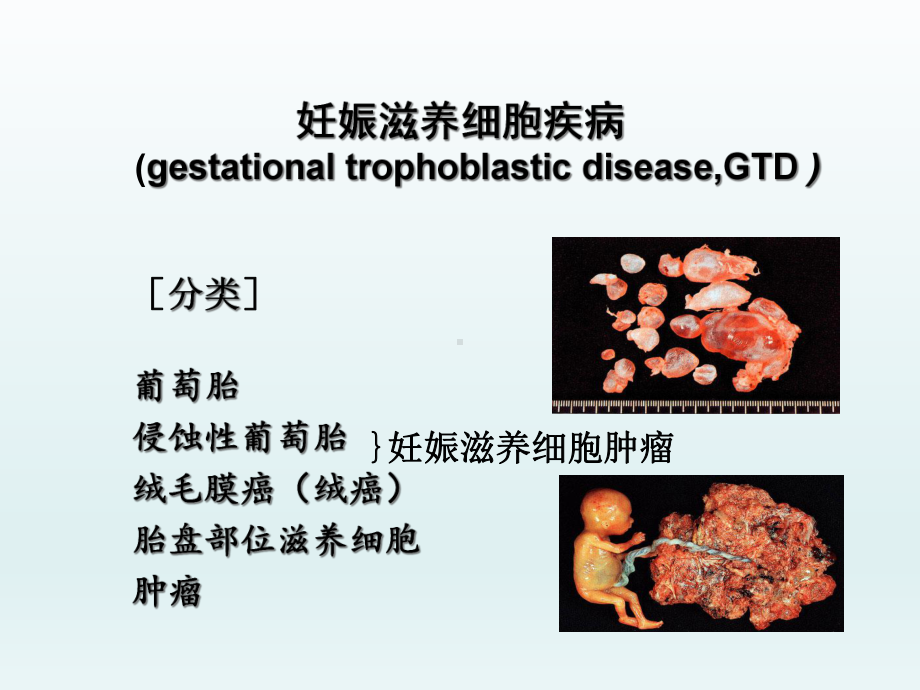 妇产科学-妊娠滋养细胞疾病课件.ppt_第3页