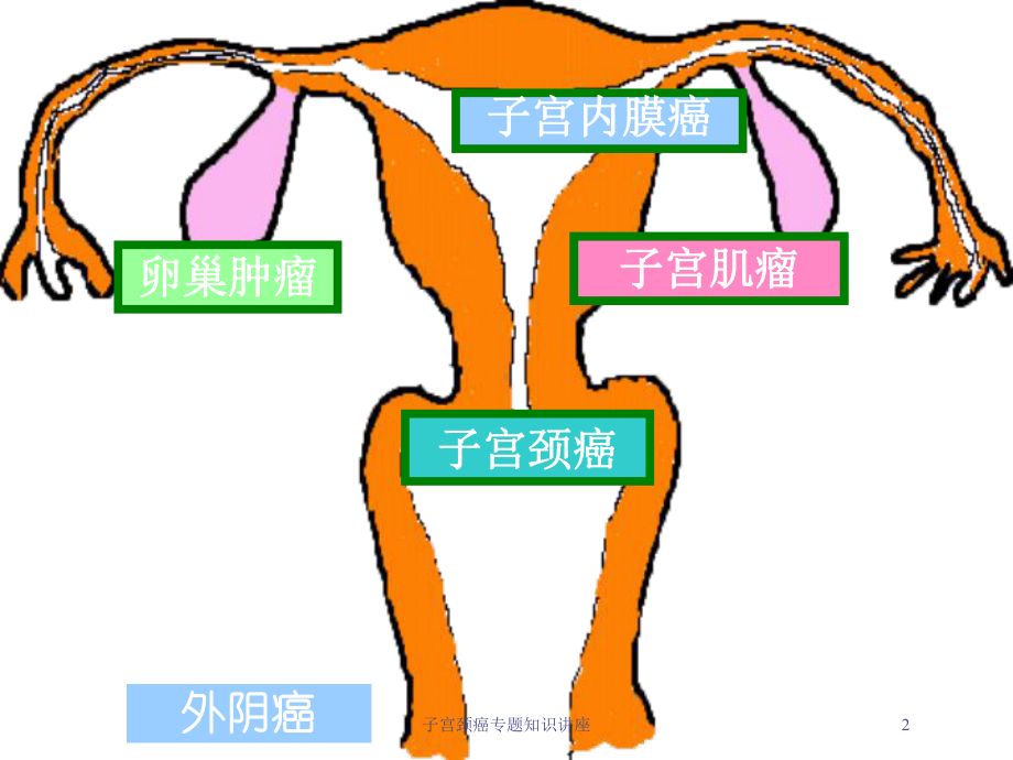 子宫颈癌专题知识讲座培训课件.ppt_第2页