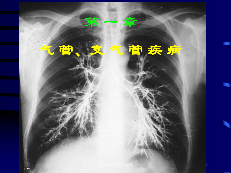 先天性支气管肺囊肿培训课件.ppt_第2页