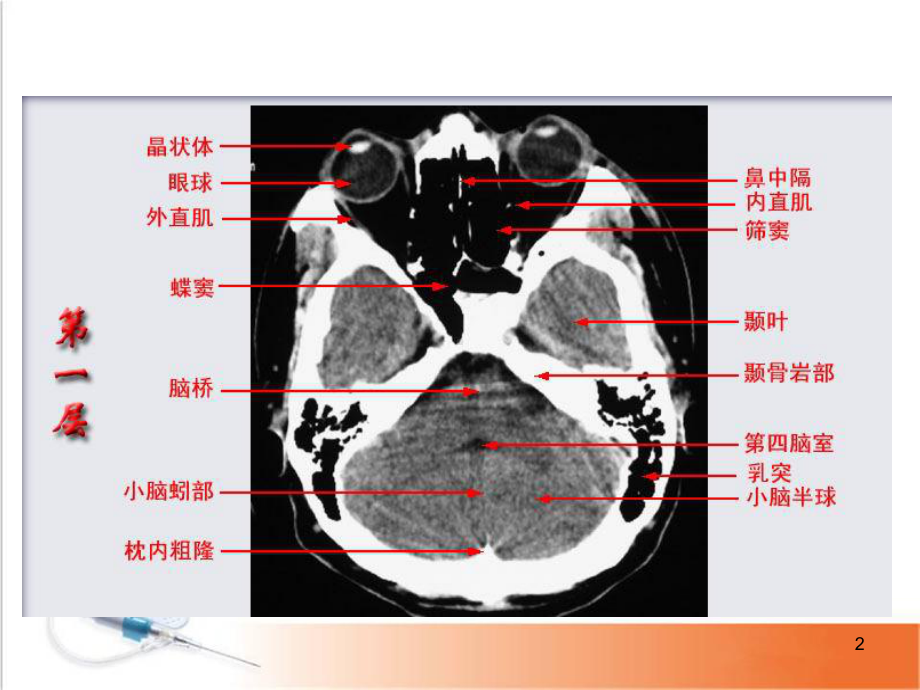 医学课件-头颅CT影像解剖课件.ppt_第2页