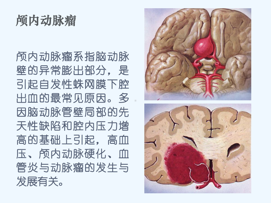 动脉瘤病人护理查房课件.ppt_第2页