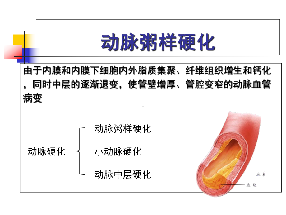 冠状动脉粥样硬化性心脏病概论课件.ppt_第3页