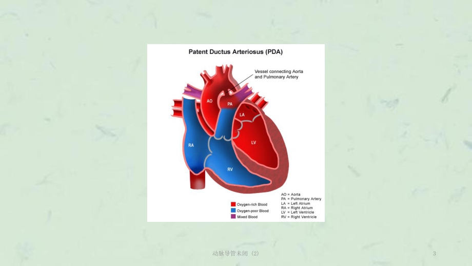 动脉导管未闭-课件.ppt_第3页