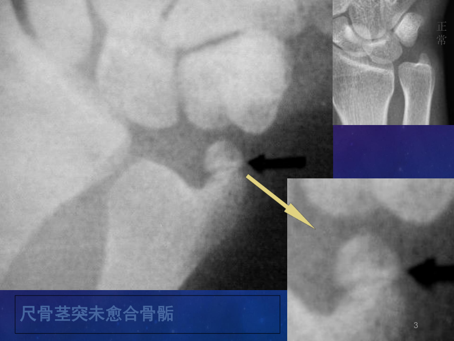 医学课件-易误认为骨折的骨骺课件.ppt_第3页