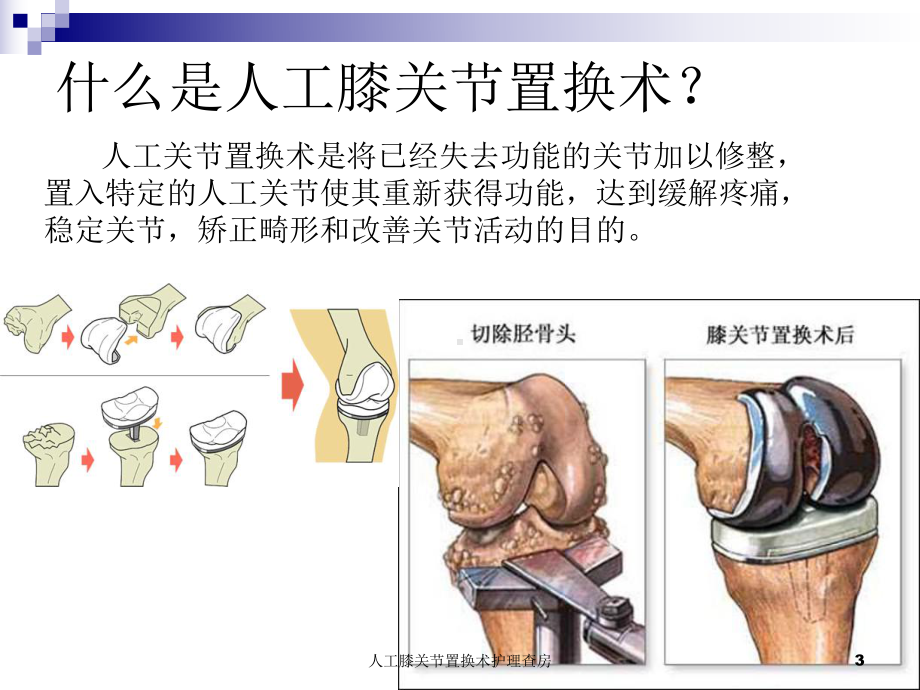 人工膝关节置换术护理查房培训课件.ppt_第3页