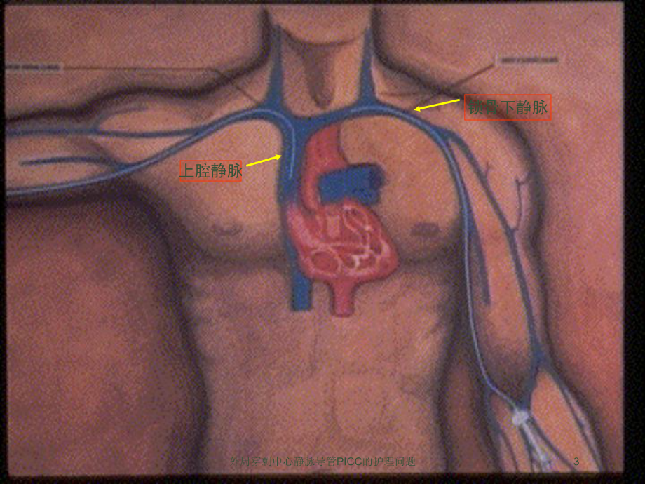 外周穿刺中心静脉导管PICC的护理问题培训课件.ppt_第3页