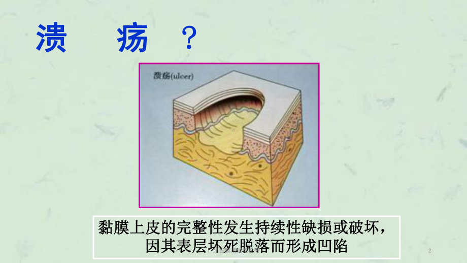 口腔黏膜溃疡类疾病课件.ppt_第2页