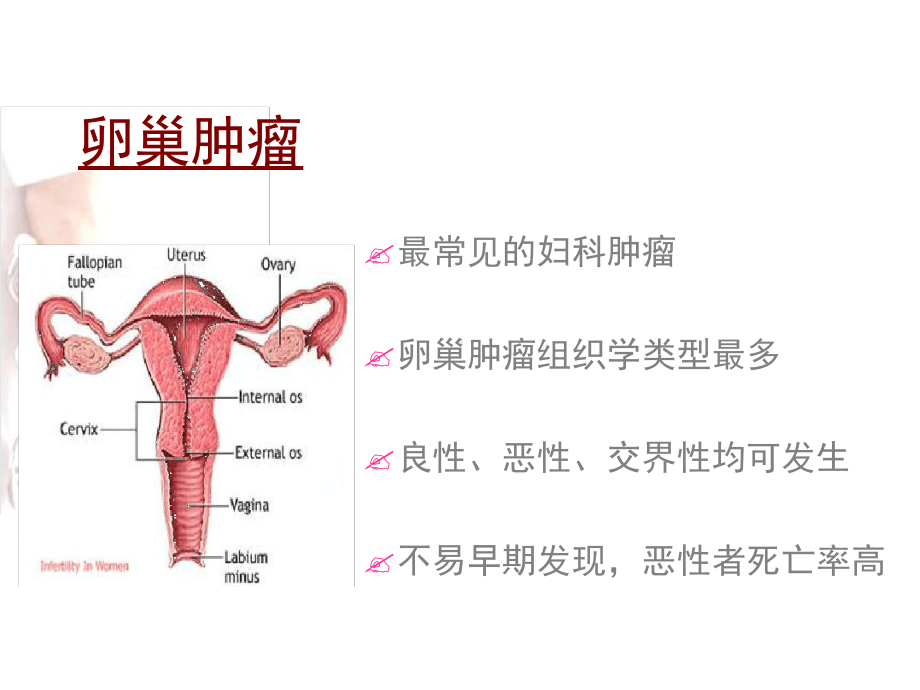 卵巢肿瘤概论概述课件.ppt_第2页