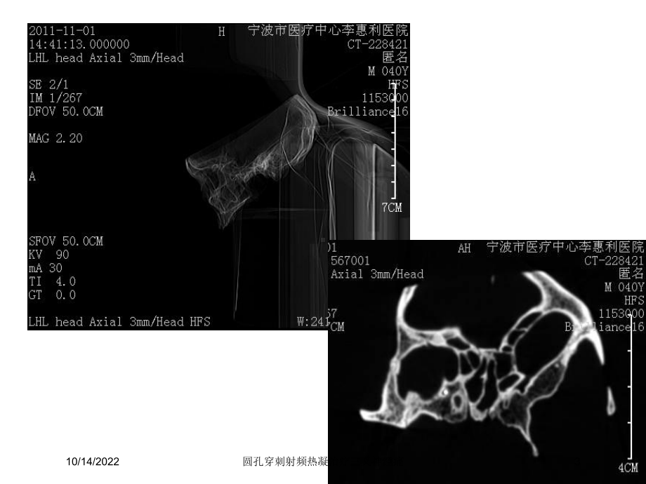 圆孔穿刺射频热凝治疗三叉神经痛培训课件.ppt_第3页