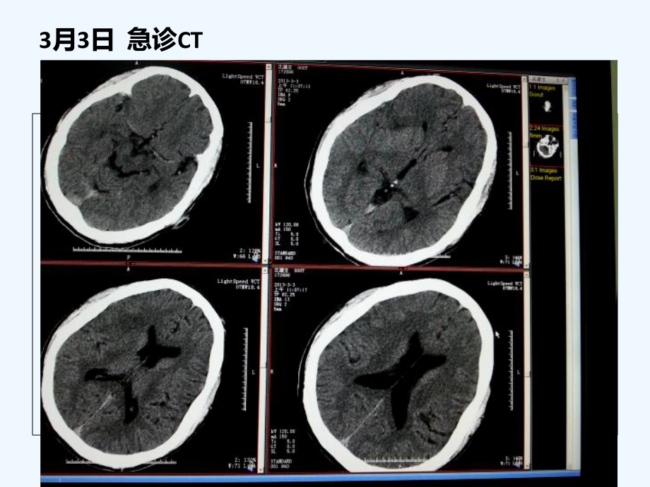 发作性抽搐病例讨论病毒性脑炎临床和影像特点课件.ppt_第3页