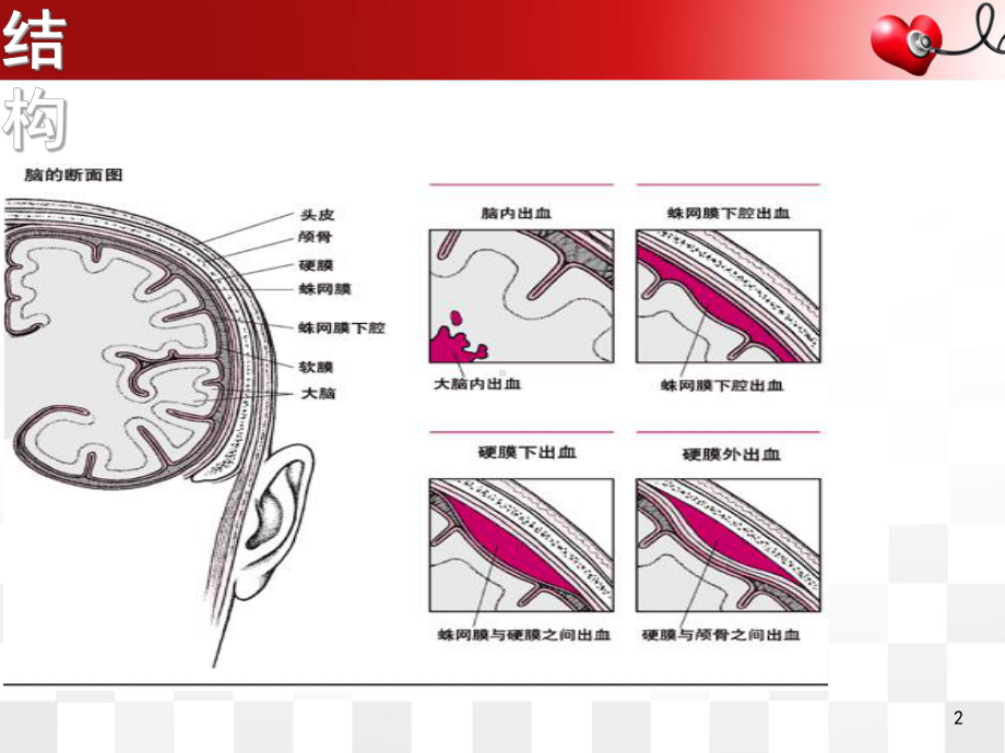 医学课件-蛛网膜下腔出血的护理要点课件.ppt_第2页