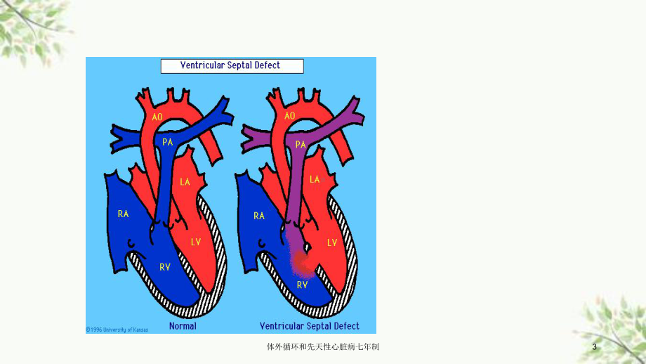 体外循环和先天性心脏病七年制课件.ppt_第3页