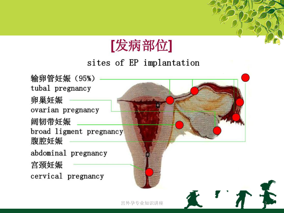 宫外孕专业知识讲座培训课件.ppt_第2页