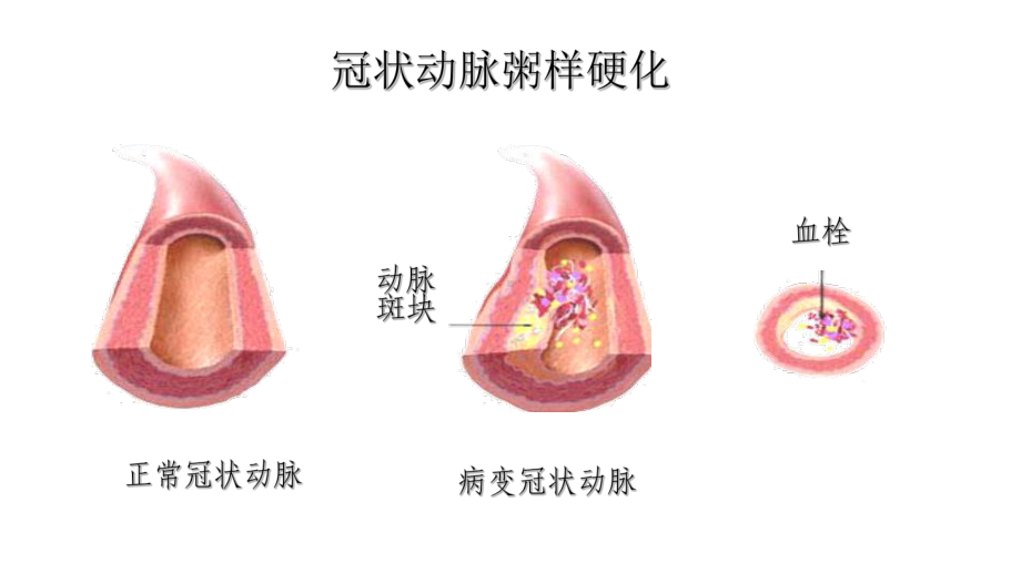 医学课件冠心病的护理查房.ppt_第3页