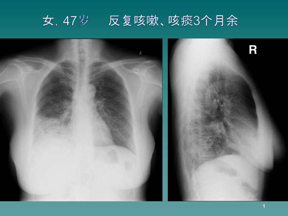 医学课件-浸润型黏液性腺癌课件.ppt_第1页