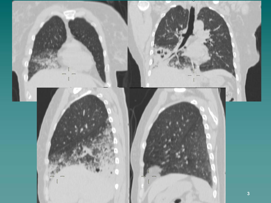 医学课件-浸润型黏液性腺癌课件.ppt_第3页