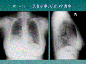 医学课件-浸润型黏液性腺癌课件.ppt