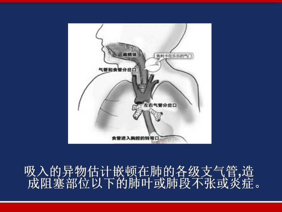 小儿气管异物取出术的麻醉处理-课件.ppt_第3页