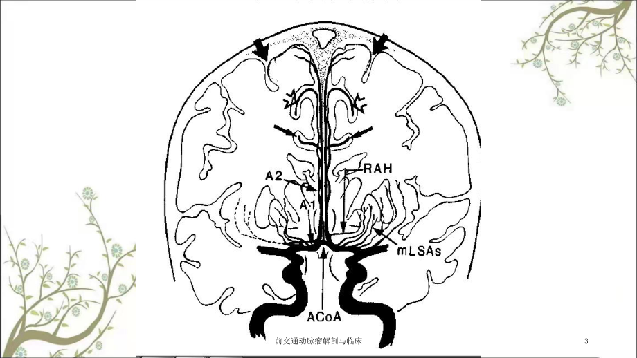 前交通动脉瘤解剖与临床课件.ppt_第3页
