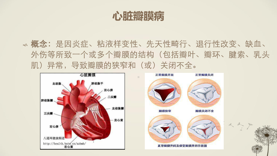 二尖瓣狭窄-课件.ppt_第3页