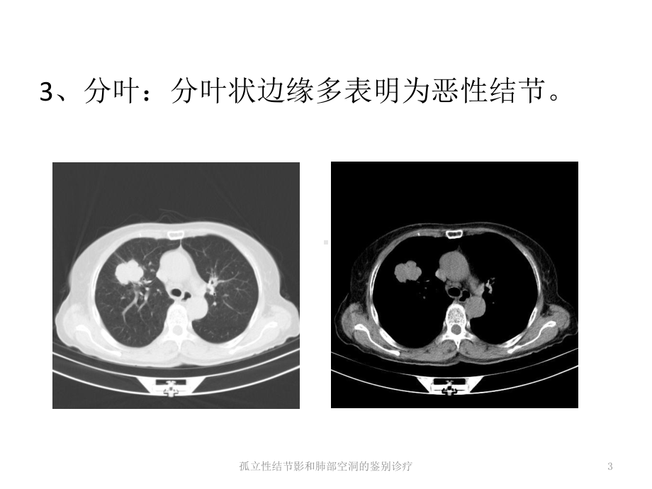 孤立性结节影和肺部空洞的鉴别诊疗培训课件.ppt_第3页