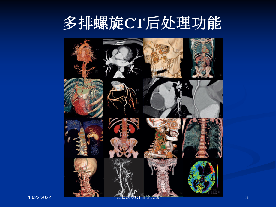 冠状动脉CT血管成像课件.ppt_第3页