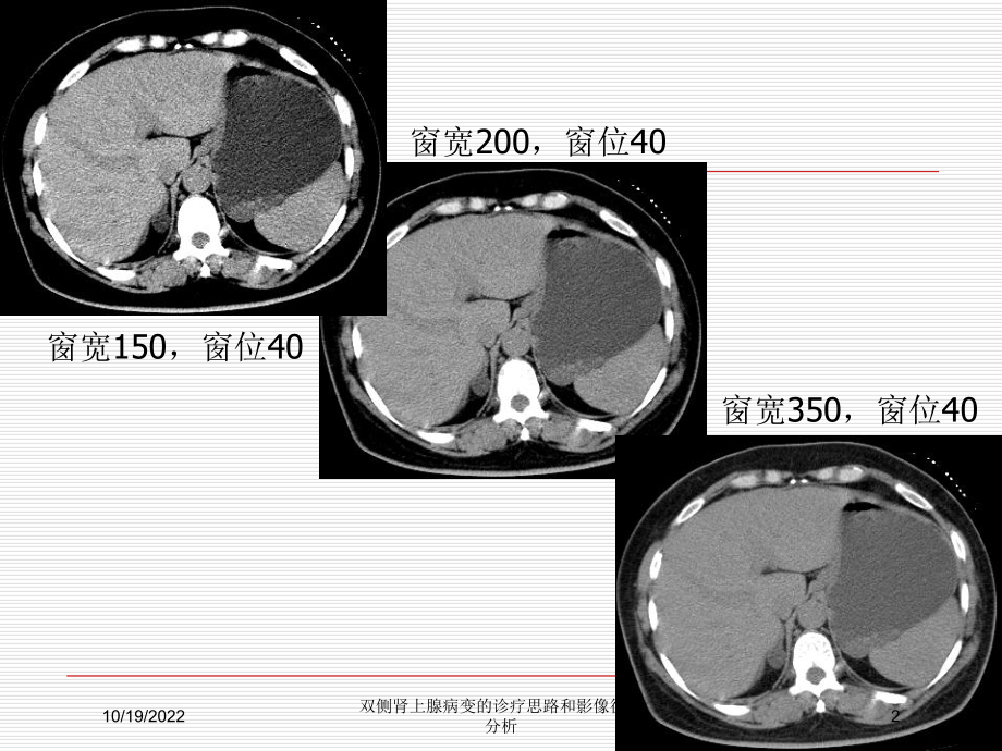 双侧肾上腺病变的诊疗思路和影像征像分析课件.ppt_第2页