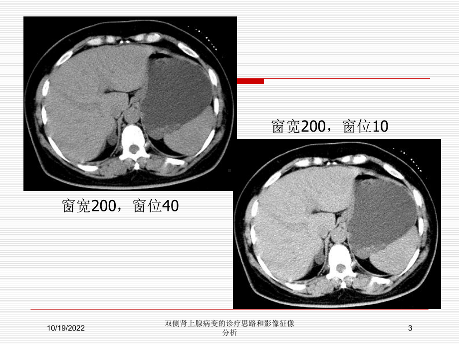 双侧肾上腺病变的诊疗思路和影像征像分析课件.ppt_第3页