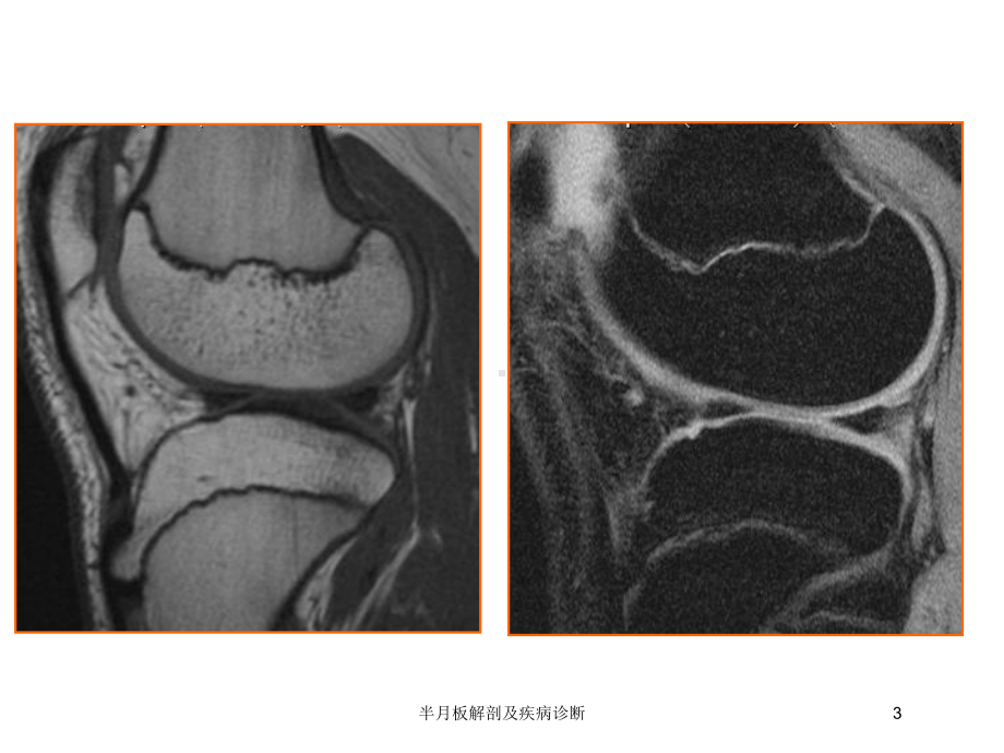 半月板解剖及疾病诊断培训课件.ppt_第3页
