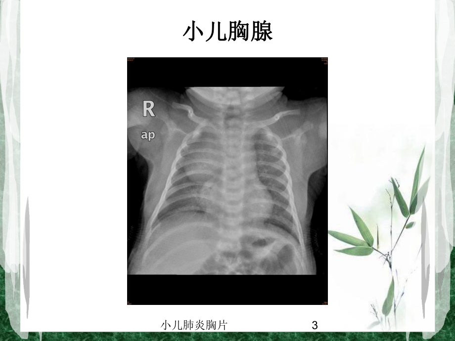 小儿肺炎胸片培训课件.ppt_第3页