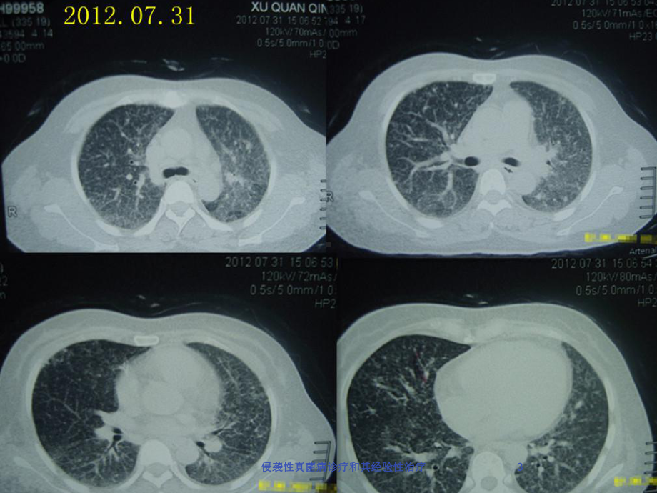 侵袭性真菌病诊疗和其经验性治疗培训课件.ppt_第3页