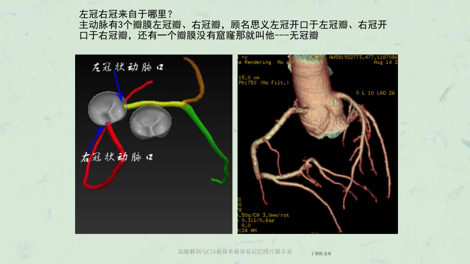 冠脉解剖与CTA最简单最容易记忆图片最丰富课件.ppt_第3页