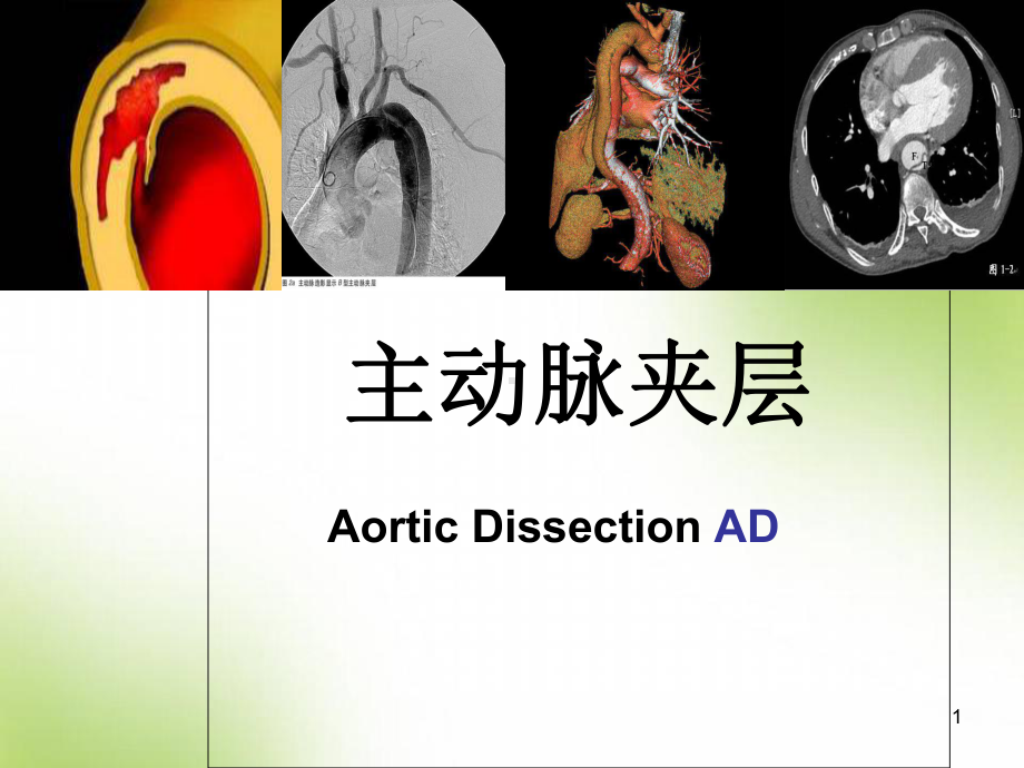 医学课件-主动脉夹层课件-2.ppt_第1页