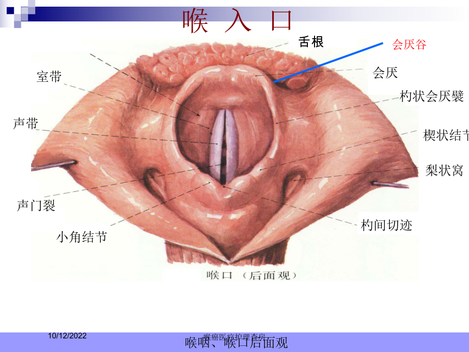 喉癌医疗护理查房课件.ppt_第3页