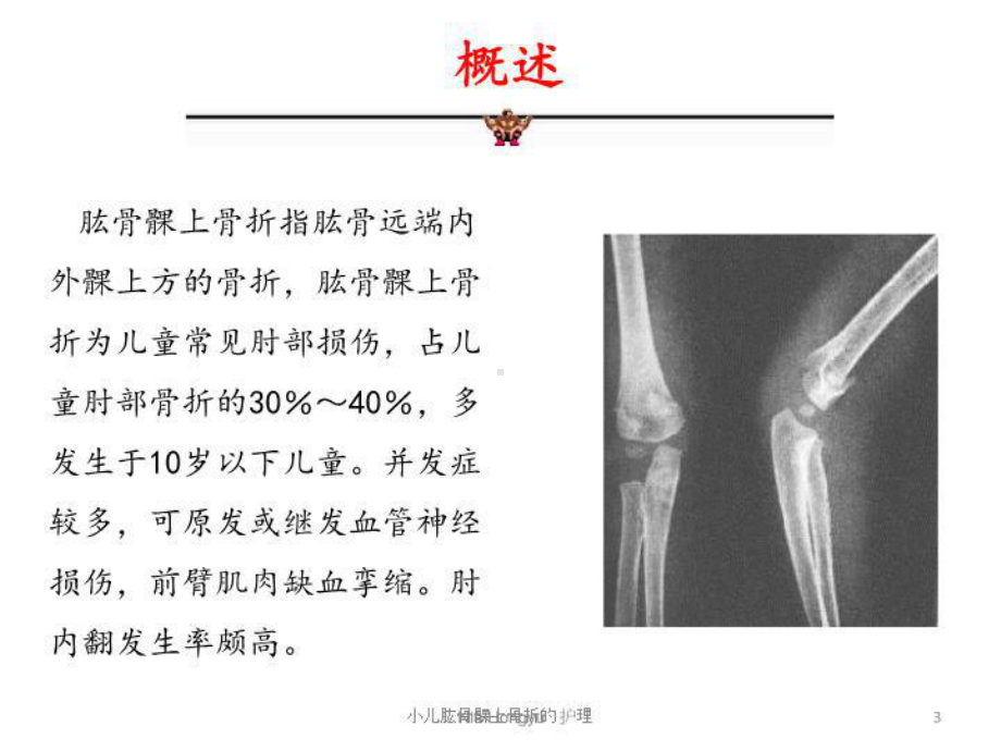 小儿肱骨髁上骨折的护理培训课件.ppt_第3页