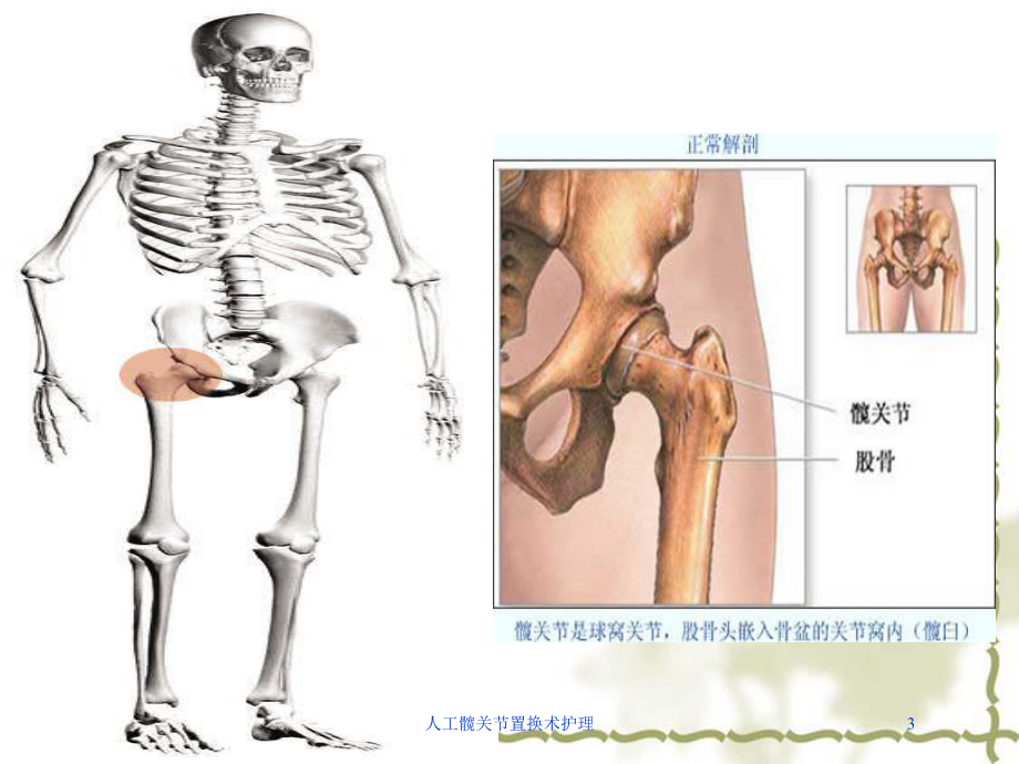 人工髋关节置换术护理培训课件.ppt_第3页