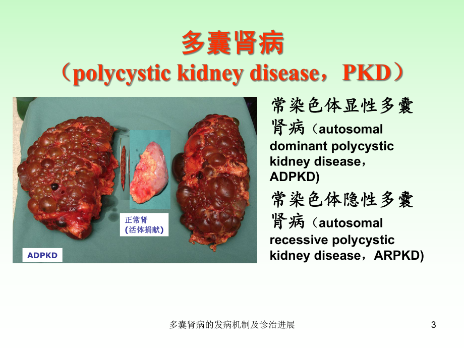 多囊肾病的发病机制及诊治进展课件.ppt_第3页