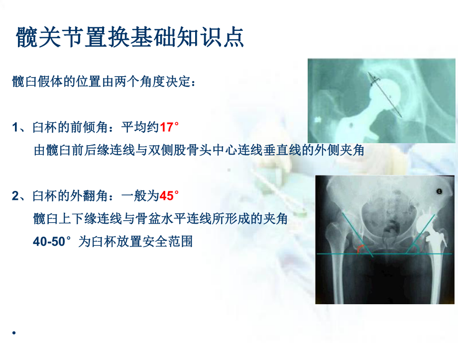 人工髋关节置换基础知识点课件.pptx_第2页