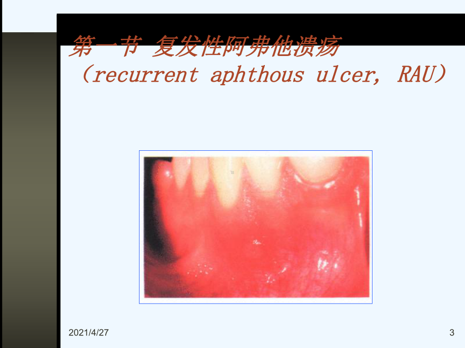 口腔粘膜病教学课件.ppt_第3页