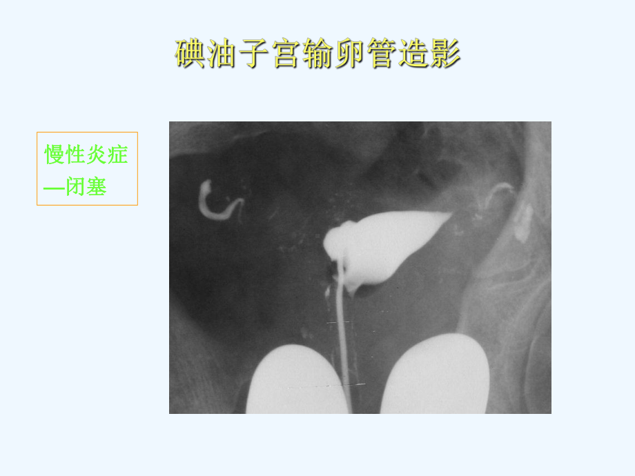 子宫输卵管造影和输卵管再通术课件.ppt_第3页