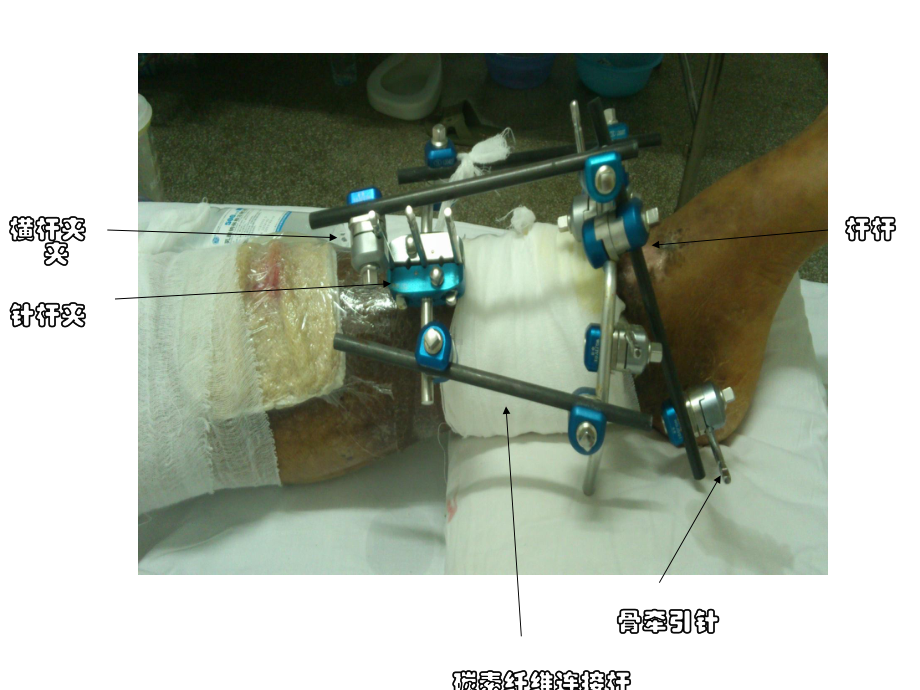 外固定支架的护理-课件.ppt_第3页