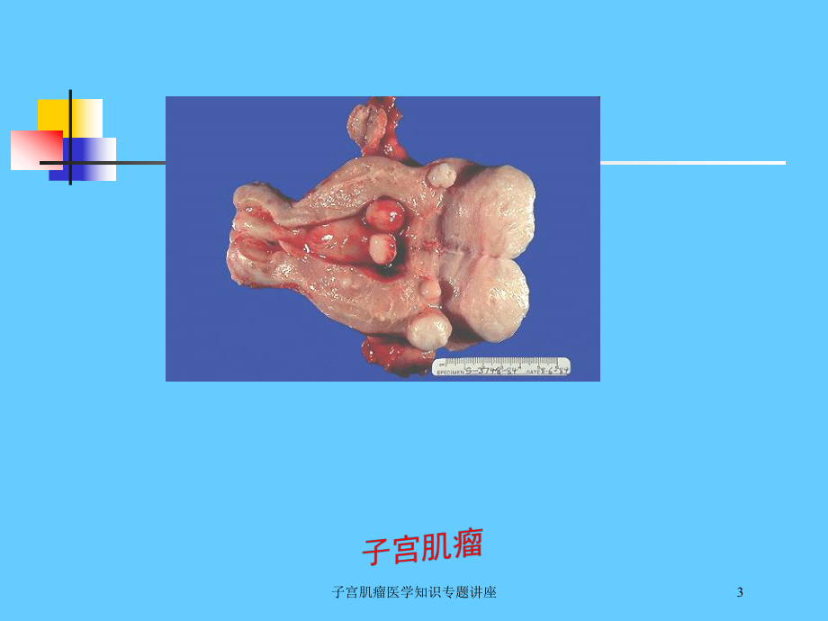 子宫肌瘤医学知识专题讲座培训课件.ppt_第3页