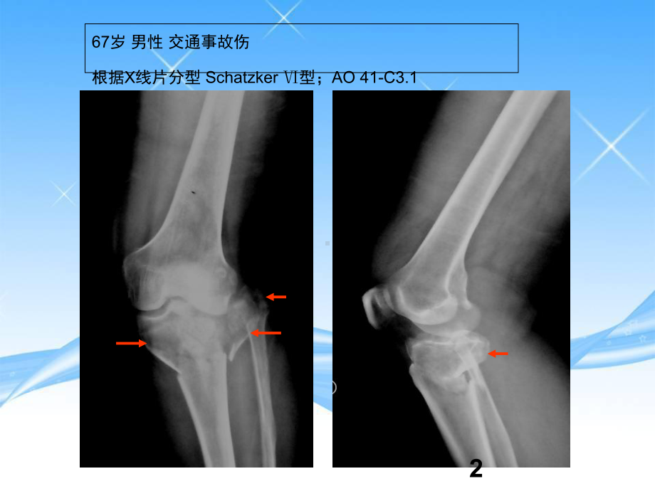 外侧扩大入路治疗胫骨平台骨折学习课件.ppt_第2页