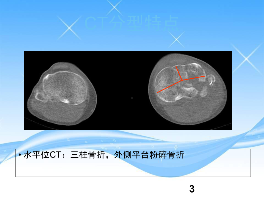 外侧扩大入路治疗胫骨平台骨折学习课件.ppt_第3页