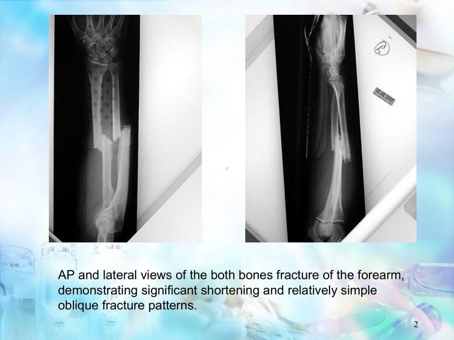 前臂双骨折的手术入路学习课件.ppt_第2页