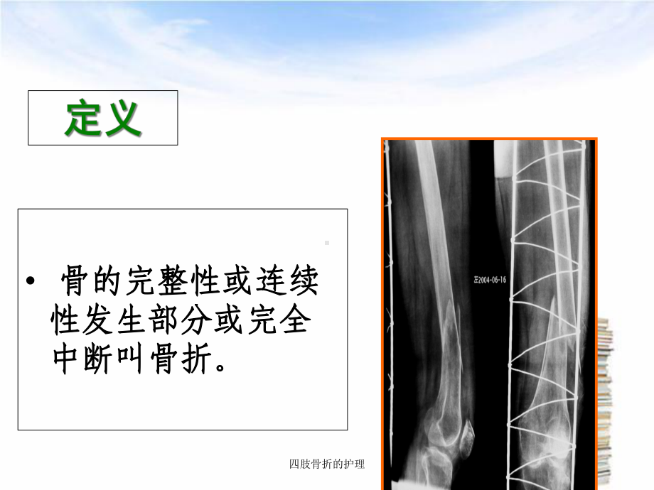 四肢骨折的护理培训课件.ppt_第3页