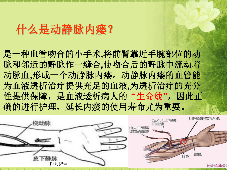 动静脉内瘘的围手术期护理(医疗知识)课件.ppt_第3页