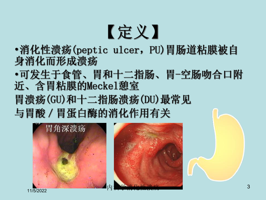 内科学消化性溃疡培训课件.ppt_第3页